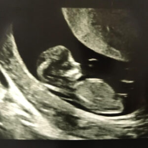 first trimester 12 week scan