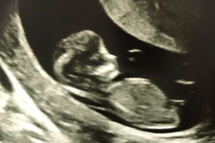 first trimester 12 week scan
