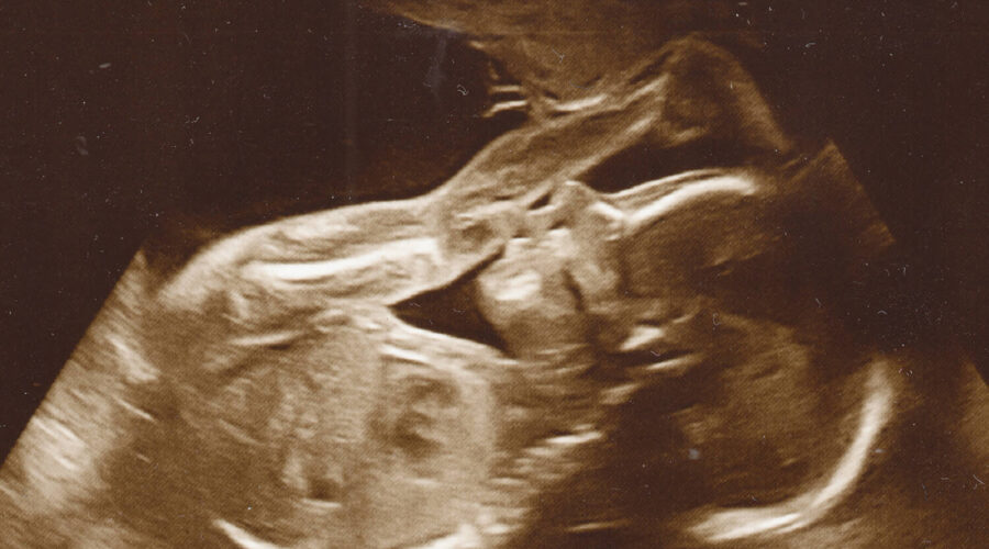 second trimester 20 week scan