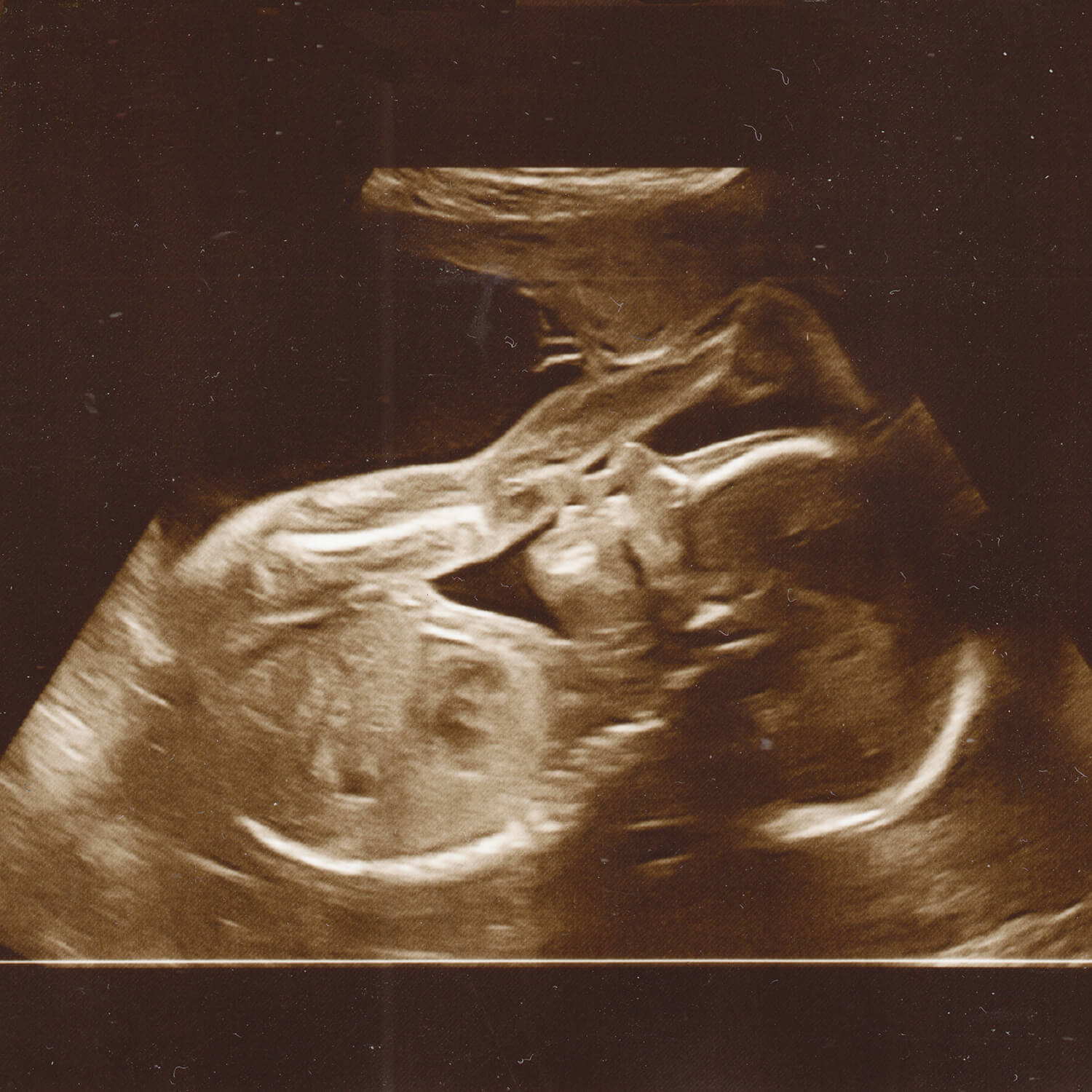 second trimester 20 week scan